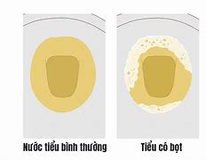 Bọt Nước Tiểu Báo Lâu Thì Tan